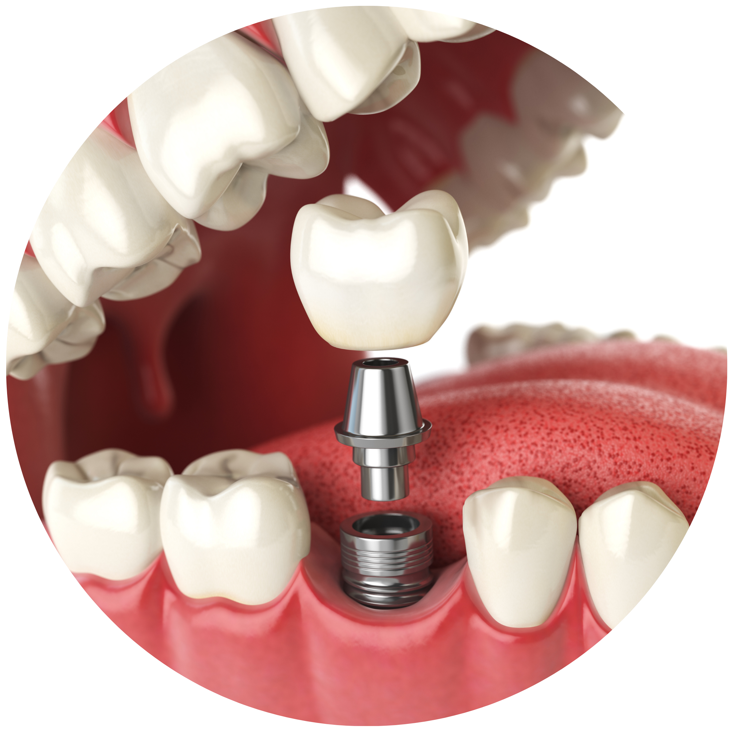 Implantdiagram2