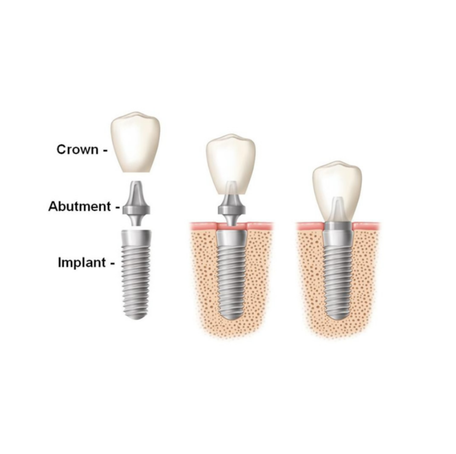Implantdiagramround