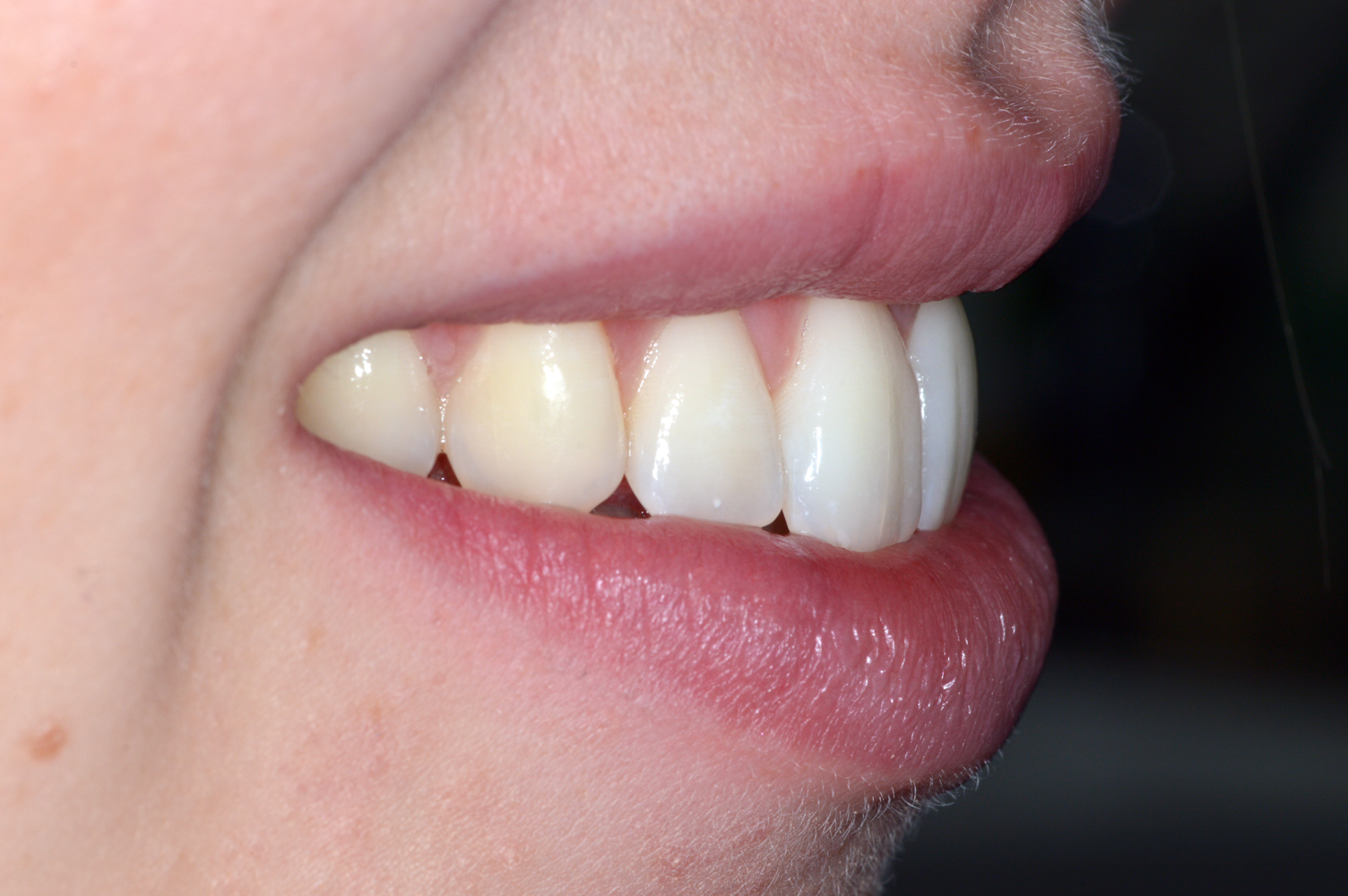 After Invisalign (+ edge bonding) – aligned teeth (lateral view)