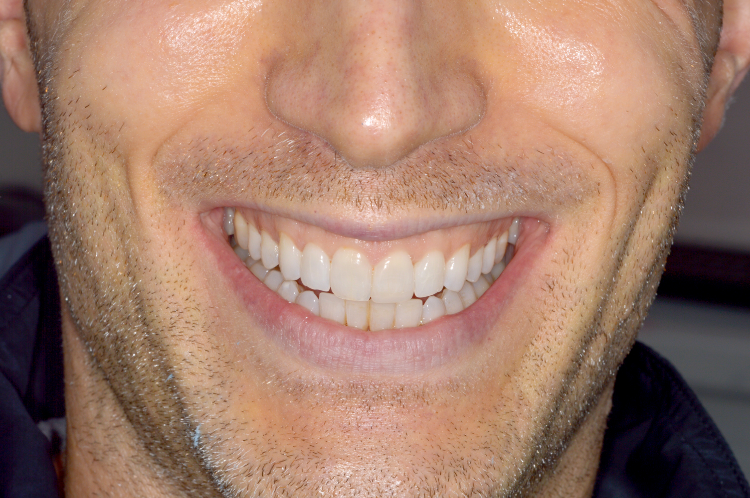 After Invisalign – aligned smile (front view)