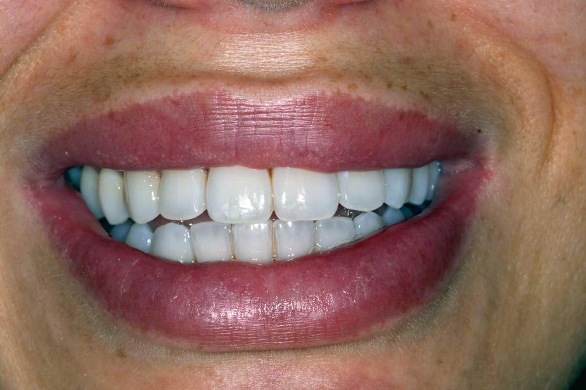 After Invisalign – aligned smile (front view)