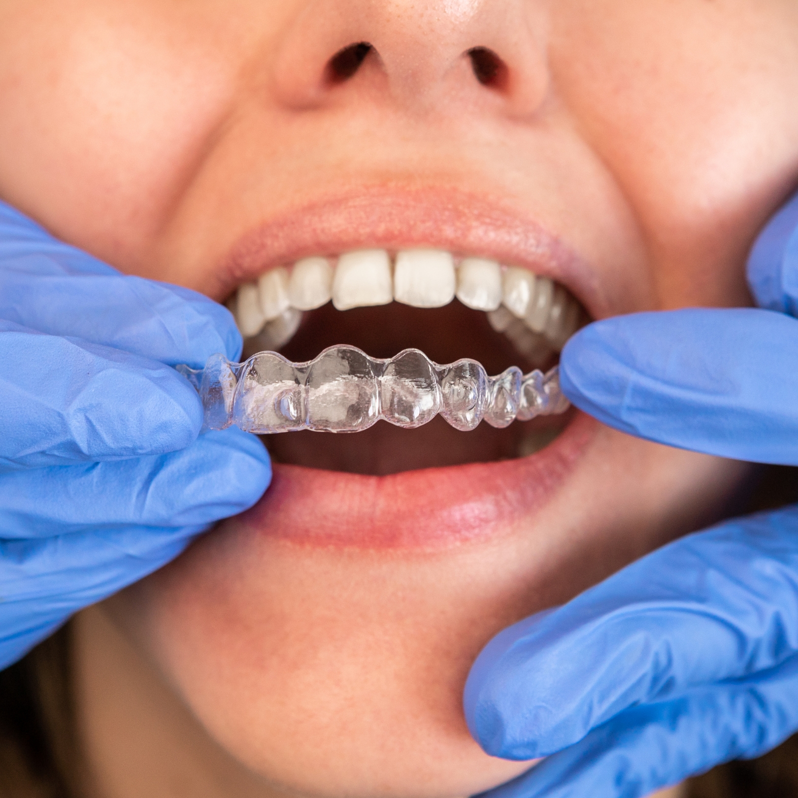 Invisalign aligners being fitted
