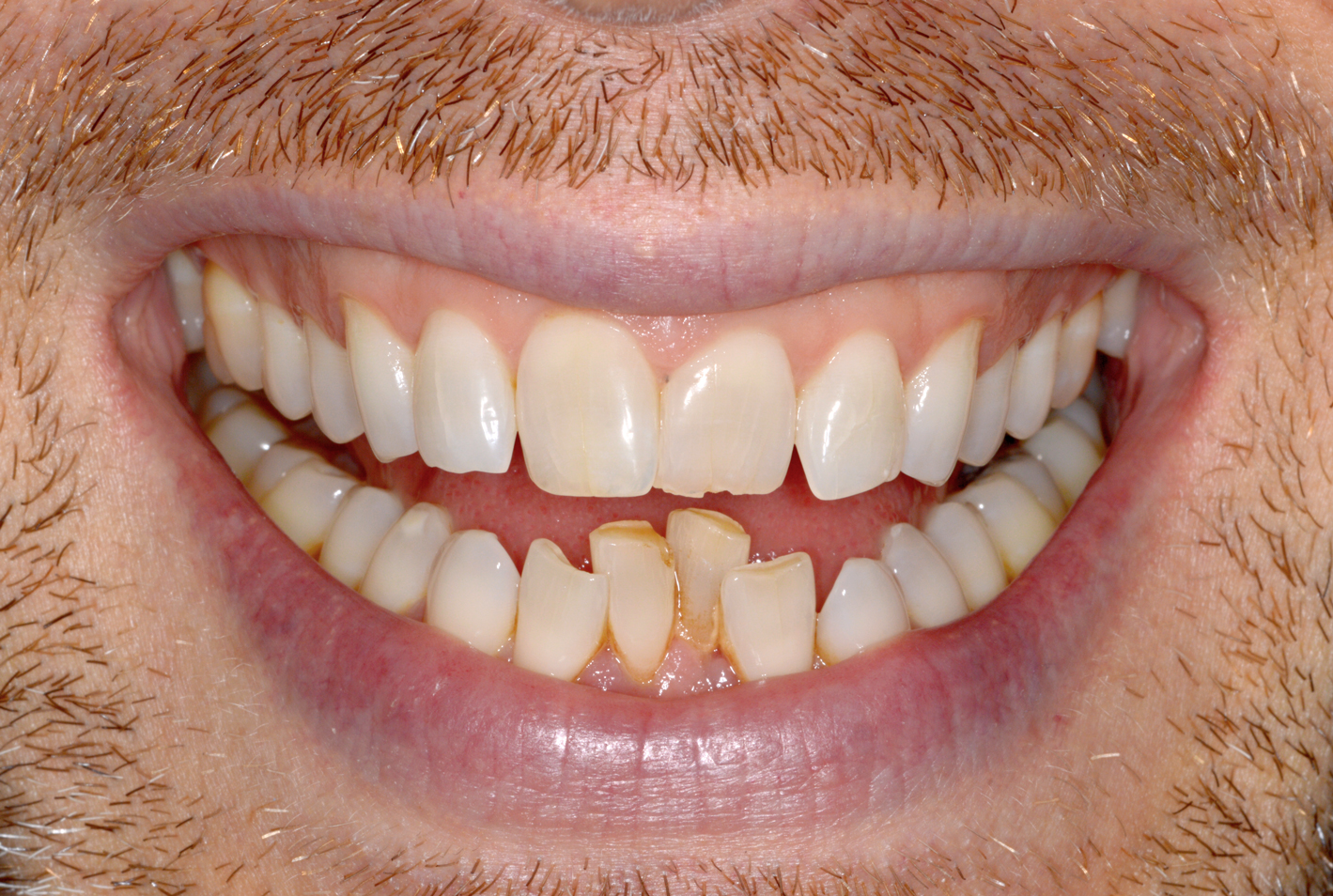 Before Invisalign – spacing (front view)