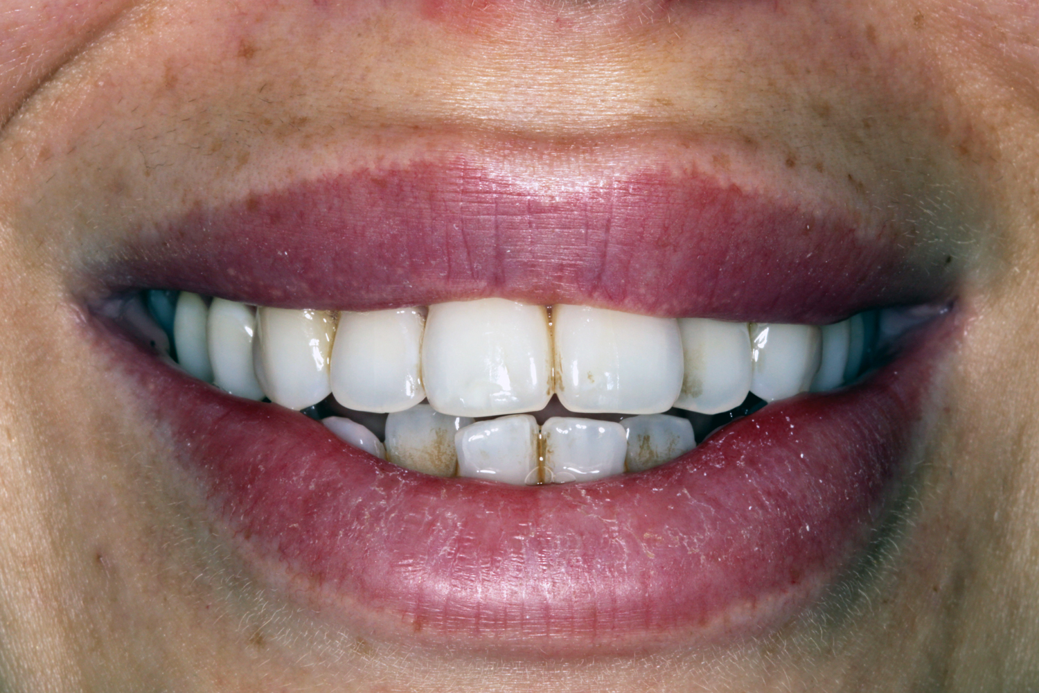 Before Invisalign – crowding (front view)