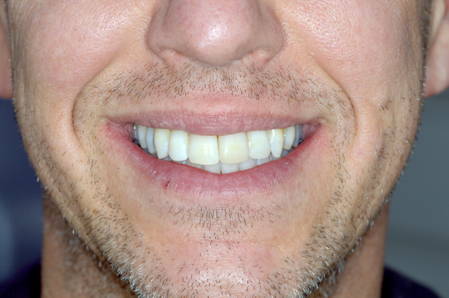 After Invisalign – aligned smile (front view)