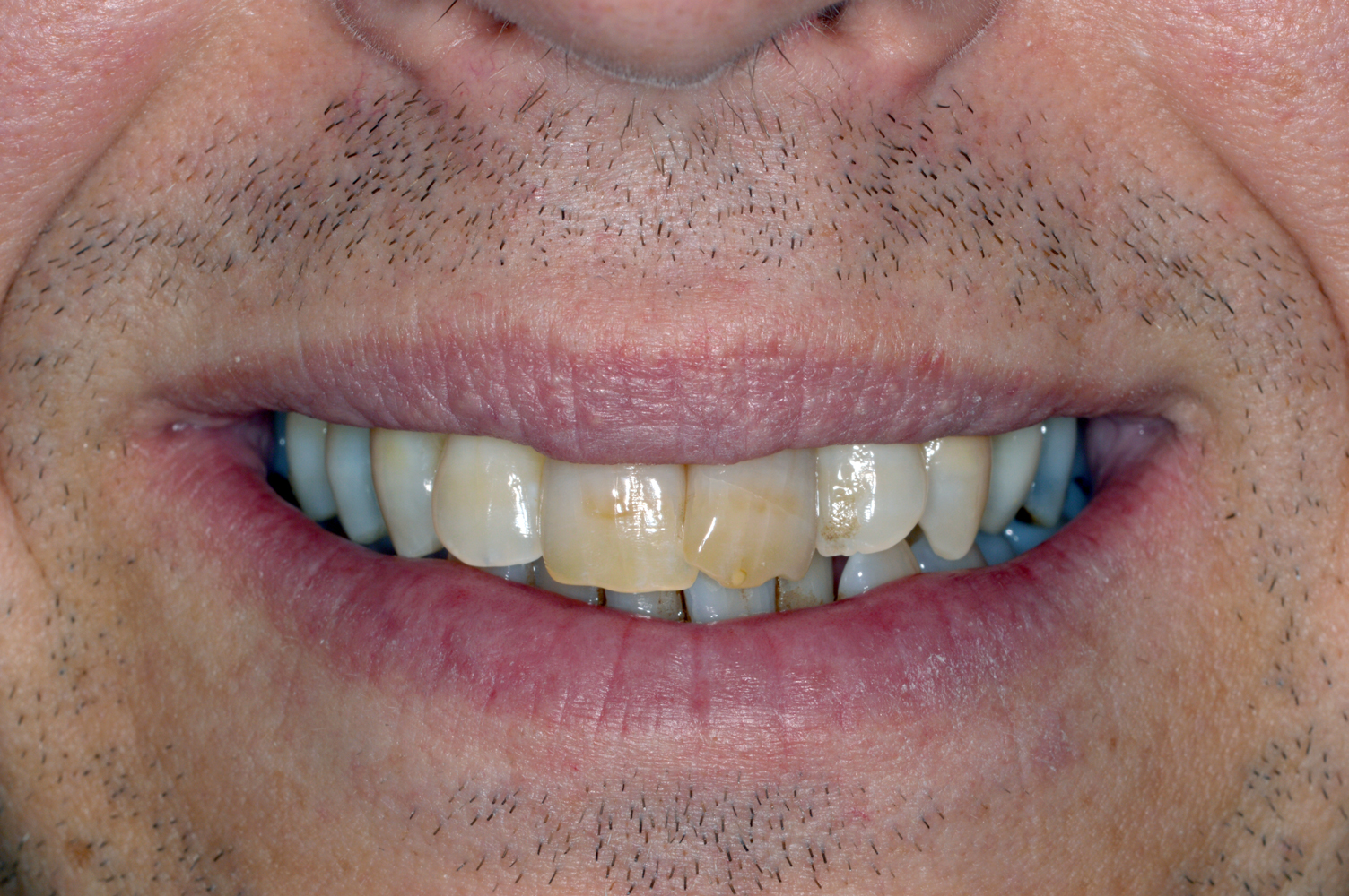 Before Invisalign – crowding (front view)